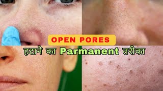 OPEN PORES  हटाने का PARMANENT तरीका