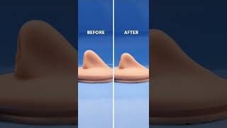 Nose Repairing #rhinoplasty #reconstructivesurgery #mbbsstudent #fypシ #viral #trending #shortsvideo