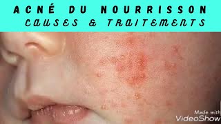 Acné du nourrisson causes & traitements