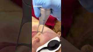 Laser Hair Bleaching for Face | Painless Facial Hair Lightening Treatment