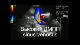 Дефект межпредсердной перегородки sinus venosus (высокий дефект в области устья верхней полой вены)