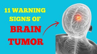 11 Warning Signs of Brain Tumor - Brain Tumor Symptoms