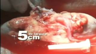 TV Cidade Verde mostra como é feita a cirurgia de transplante de rim