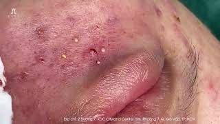 Big Cystic Acne Blackheads Extraction Blackheads & Milia, Whiteheads Removal Pimple Popping