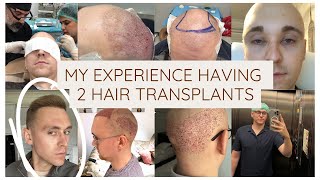 2 Hair transplants later! The Good & Bad...