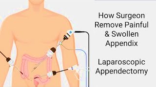 Laparoscopic Appendectomy - Appendix Removal Surgery - How Surgeon Remove Painful & Swollen Appendix