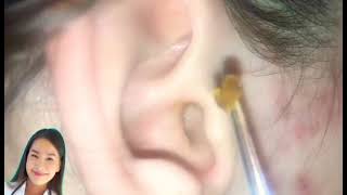 Dr.Nattacha, earcleaning, big earwax removal,