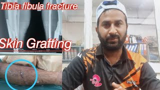 Tibia fibula fracture recovery || Kia mera skin grafting huna chahiye tha? || @fahadinfo124