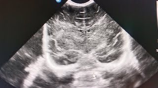 A neonate with HIE - loss of cerebral autoregulation