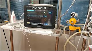 Medical Education Video: Neonatology: Difference in Pre-ductal & Post-ductal SpO2 in PPHN