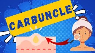 Carbuncles: Definition, Symptoms, Causes, And Treatment | Comprehensive Guide About Carbuncles