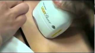 Laser Hair Removal, Intense Pulsed Light, San Jose, (877) 6