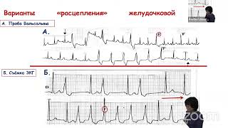 Об истории изучения желудочковой парасистолии в нашей стране. Начало...