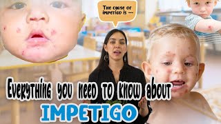 Everything you need to know about impetigo!