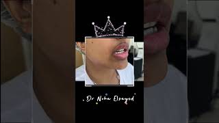 راي مراجعتي الجميله 🥰( تحديد فك مع  بوتكس وفيلر شفايف ) rejuvenation #botox #lip #الذكاء_الاصطناعي