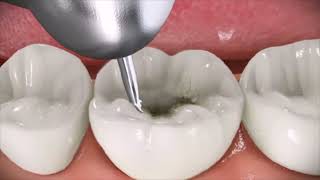 Endodontics   Root Canal Therapy