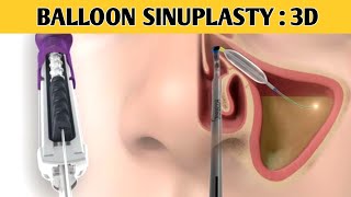 "Balloon Sinuplasty: Your Ultimate Guide to Relief from Chronic Sinusitis"