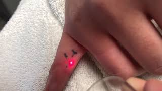 Finger tattoo , laser tattoo removal