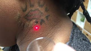 Laser tattoo removal on neck African American (black) female