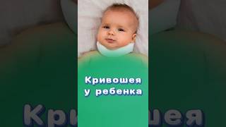 Когда лечить кривошею?! #кривошея #центрздоровья #титовцентр