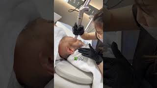 Facial Treatment To Look Younger (Pico Laser)