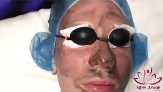 3D Skin rejuvenation