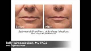 Radiesse Injections Juvederm Santa Monica Brentwood Beverly Hills Facial Fillers