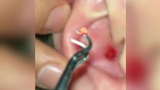 GROSS EAR PIMPLE