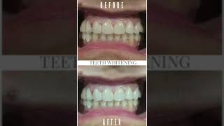 #shorts #youtubeshorts #teethwhitening Teeth Whitening | Dentalks | Subscribe