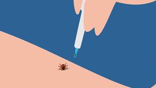 How to properly remove a tick from skin?