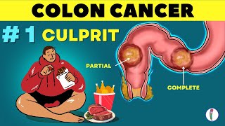 # 1 🔥 Cause of Colon Cancer & how to prevent it | Colon Cancer - causes | Rectal cancer