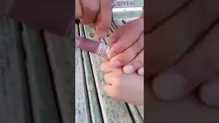 How to remove a ring stuck on your fingerКак удалить кольцо, застрявшее на пальце...