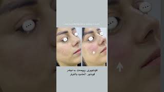 Cheek contouring using dermal filler