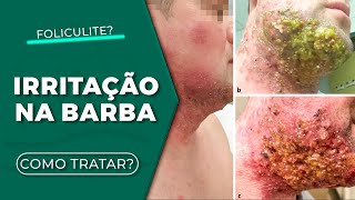 Coceira e barba irritada I Como se livrar de vez da foliculite