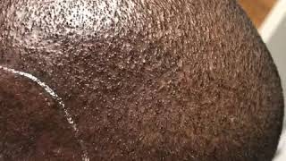 Scalp micropigmentation on head laser tattoo removal on black female