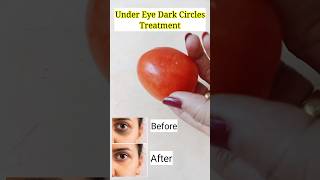 Under Eye Dark Circles Treatment #shorts #ytshorts #youtubeshorts