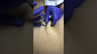 Celuliti,metodat e trajtimit. Dr. Brunilda Bardhi performing live Cellulite treatment.