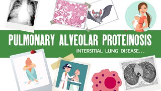 Pulmonary Alveolar Proteinosis | pulmonary alveolar proteinosis radiology pathology histology causes