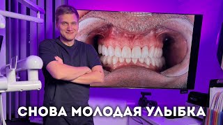 Снова молодая улыбка — тотальная реабилитация, которая позволила сбросить несколько десятков лет