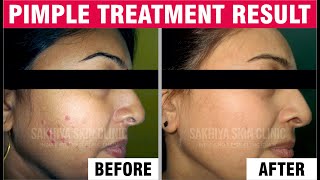 Effective Pimple Treatment: Clear Skin | Pimple Treatment | Skin Glow | Testmonials