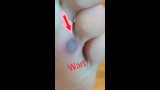 Cure plantar warts