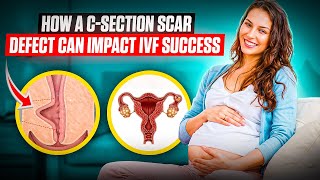 IVF success lower because of C-Section scar? - 3 tips to improve your odds