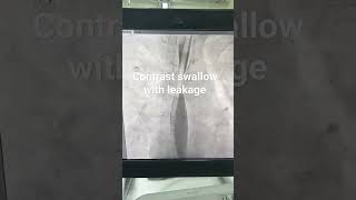 Contrast swallow with leakage #class #radiology #biology #diagnosticradiology