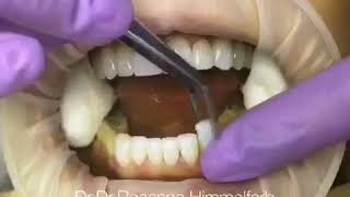 Zahnklinik Luzern - Dr.Dr.Rosanna Himmelfarb - Veneers & Lumineers