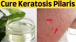 How to get rid of keratosis pilaris on face naturally on face and body