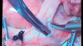 END TO SIDE MICRO-VASCULAR ANASTOMOSIS.