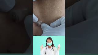 Dr.Nattacha, blackheads infected, symptômes.