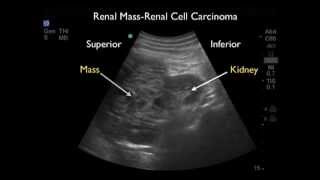 Ultrasound detection of a renal mass in a patient with flank pain and hematuria