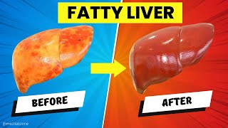 Top 5 Foods Causing Fatty Liver Disease | Must-Avoid Diet for Liver Health