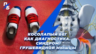 Косолапый бег как диагностика. Синдром грушевидной мышцы